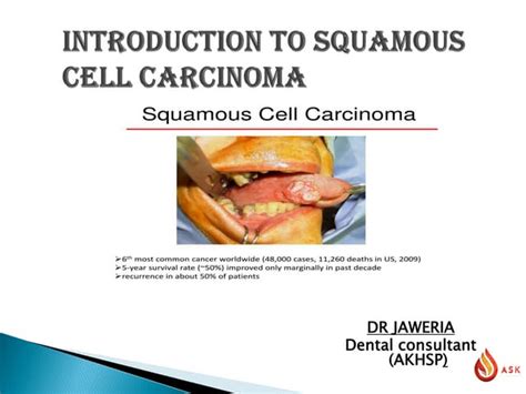 Oral Squamous Cell Carcinoma Ppt