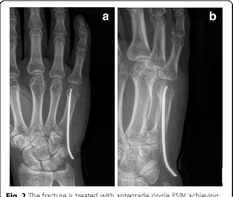 Treatment Of Fifth Metacarpal Neck Fractures With Antegrade Single