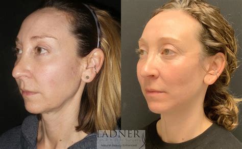 Facelift Neck Lift Before And After Pictures Case 94 Denver Co