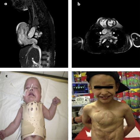 Management Of Pentalogy Of Cantrell With Complete Ectopia Cordis And