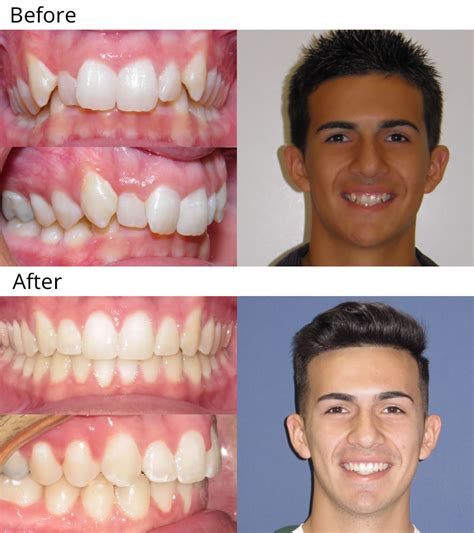 Before And After Braces Gaps