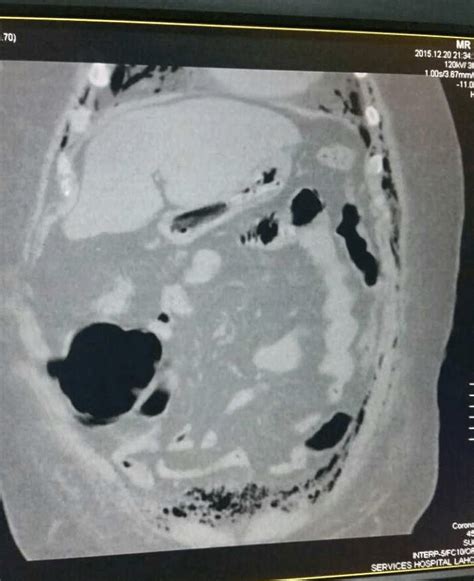 Ct Scan Showing Retroperitoneal Gas Arising From Gluteal Region