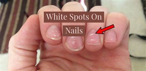 Incredible Nail White Spot Symptoms Ideas Fsabd42