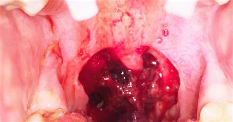 Bleeding After Tonsillectomy Pictures Fauquier Ent Blog