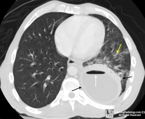 Lung Abscess Ct Scan The Thick Walled Cavitary Lesion In Flickr My