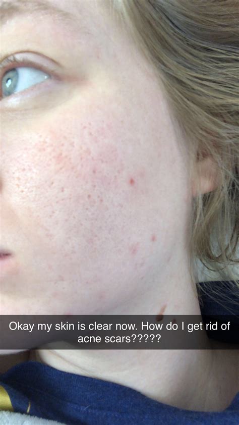 Skin Concern I Am Super Insecure With My Skin And My Cheeks Are