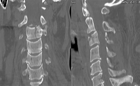 Coronal And Sagittal View Of Spine Ct Showing Fracture Of C3 Vertebral