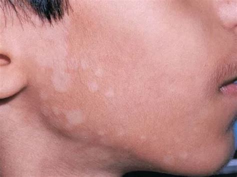 White Patches On Skin Pictures Fungus Treat Get Rid Of Dry Itchy