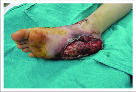 Patient foot post-degloving injury to the right heel. | Download ...