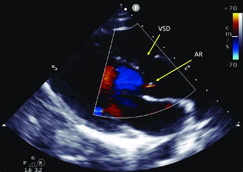 Echocardiographic Parasternal Long Axis View Showing Trivial Aortic