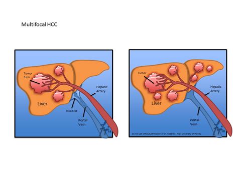 Liver Cancer Hepatocellular Carcinoma Division Of Gastroenterology
