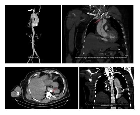 Complex Aortic Dissection With Multifaceted Clinical Presentations