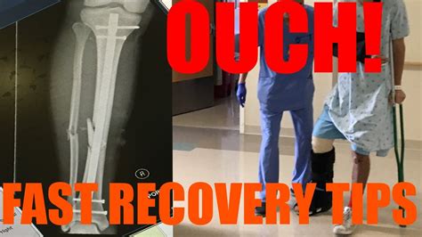 How To Recover Quickly From Broken Leg Fractured Tibia Fibula Orif