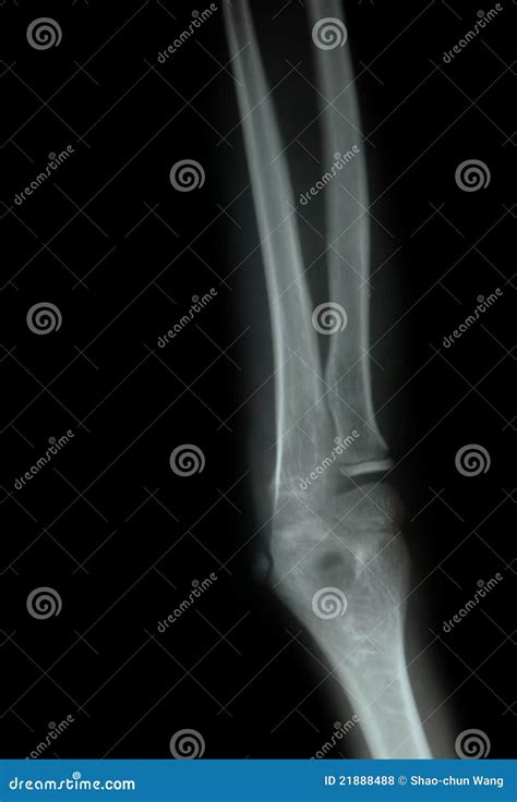 X Ray Of A Young People Arm Stock Photo Image Of Radiate Radiation