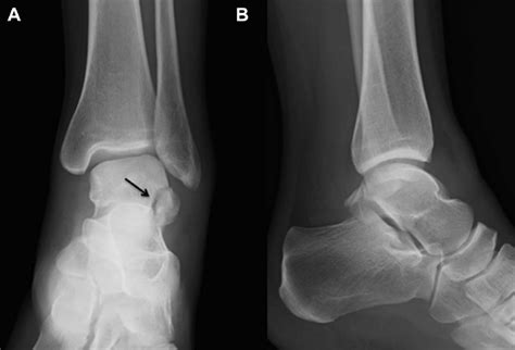 A Anteroposterior Radiograph Of The Left Ankle Joint Of A 22 Year Old