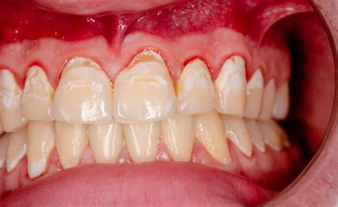 What Is Gingivitis Aesthetica Dental Clinic In New Alipore