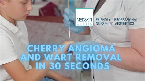 Cherry Angioma Home Remedy Vs Cryotherapy Private Clinic