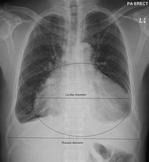 Chest Radiograph Signs Suggestive Of Pericardial Disease American
