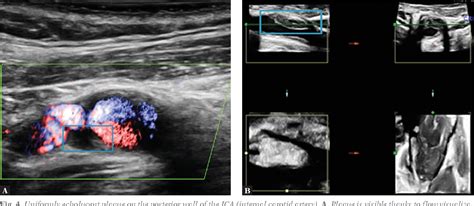 Figure From Ultrasonography Of Vulnerable Atherosclerotic Plaque In