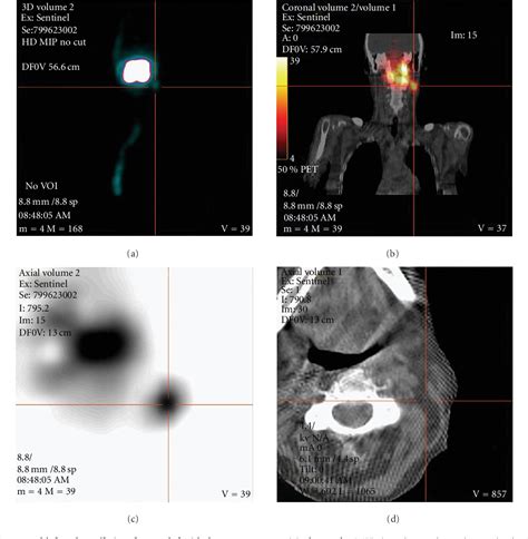 Figure 1 From Spectct For Lymphatic Mapping Of Sentinel Nodes In Early