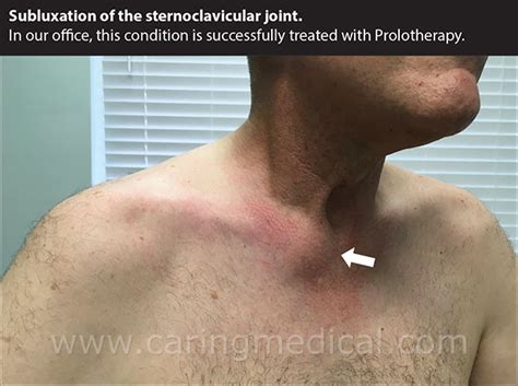 Sternoclavicular Joint Injury And Instability Caring Medical Florida