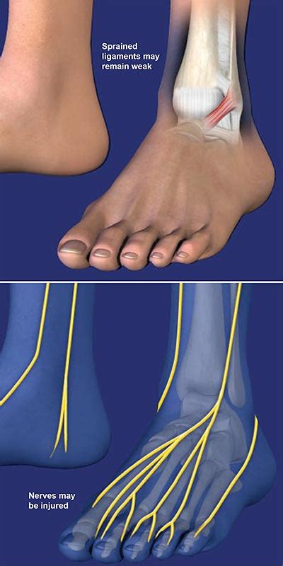 Chronic Lateral Ankle Pain Central Coast Orthopedic Medical Group