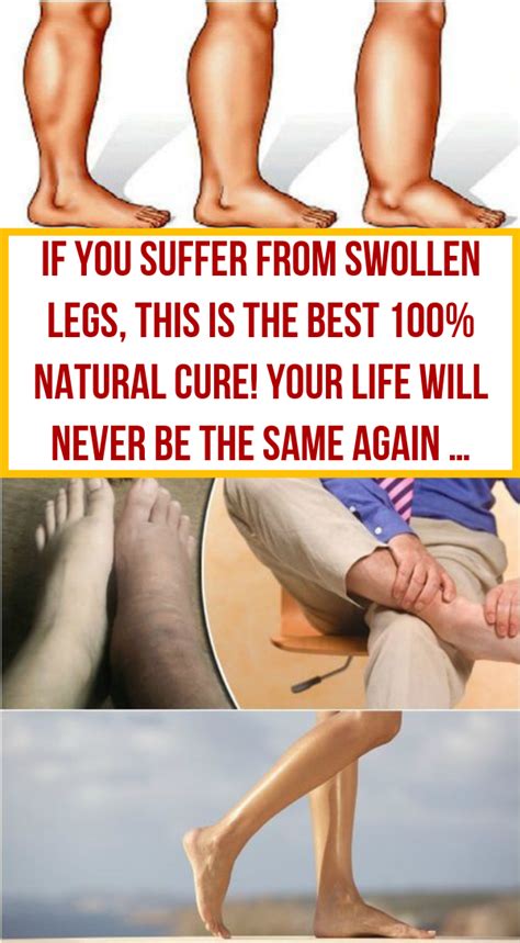 If You Suffer From Swollen Legs This Is The Best 100 Natural Cure Your Life Will Never Be The