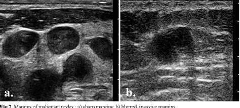 Figure 7 From Ultrasonography Of Superficial Lymph Nodes Benign Vs