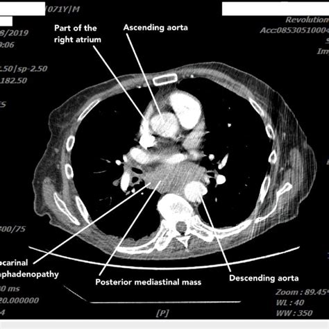 Chest Ct Scan With Contrast Showing Posterior Mediastinal Mass And