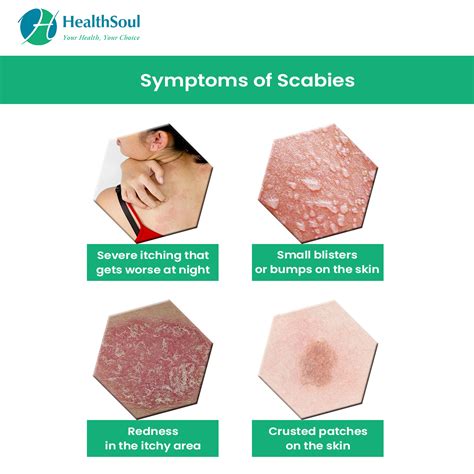 Scabies Diagnosis And Treatment Healthsoul