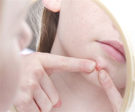 The Right Way To Pop A Pimple According To A Dermatologist Shefinds