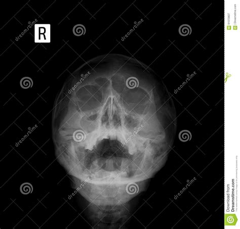 Sinusitis Film X Ray Of Human Skull With Inflamed At Sinus Stock Photography Cartoondealer