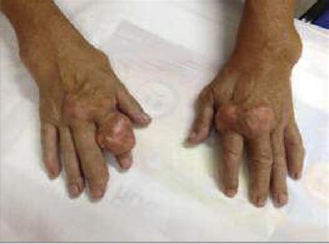 Things You Need To Know About Gouty Tophi In The Wrist Get Rid Of Gout