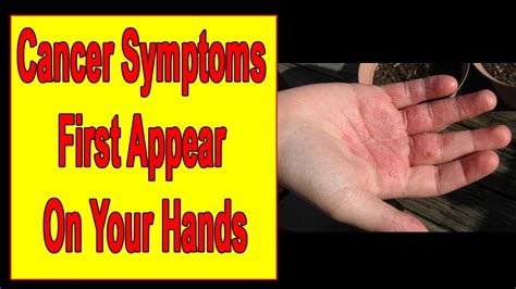 Skin Cancer Lesions On Hands