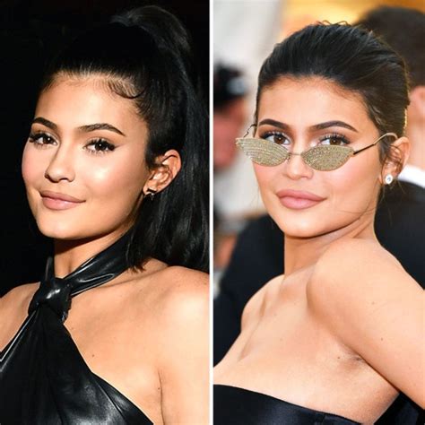 How Kylie Jenner Could Be Dissolving Her Filler Doctor Commentary