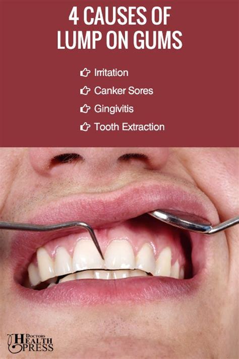 Lump On Gums Common Causes And Natural Remedies Sore Tooth Remedies