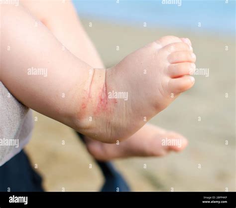 Atopic Dermatitis Newborn Feet Eczema Stock Photo Alamy