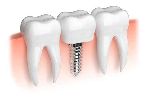 Dublin Dental Implants Tooth Replacement Options