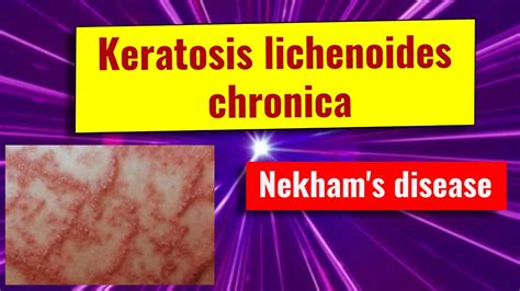Keratosis Lichenoides Chronica Overview Causes Features Management