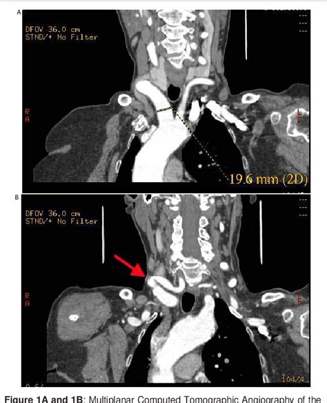 Figure 1 From Austin Of Clinical Case Reports Innominate Artery