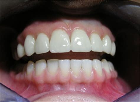 We did not find results for: Dental veneers abroad - Cheap porcelain veneers in Poland - PolishMySmile