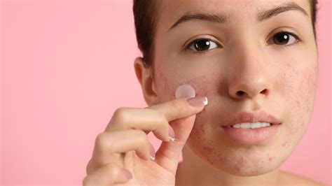 5 Reasons Your Acne Treatment Isnt Showing Results Healthdemic