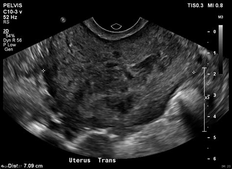Heterogeneous Uterus With Fibroids Doctorvisit