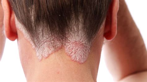 Psoriasis La Enfermedad Que Se Confunde Con Caspa Las Noticias De