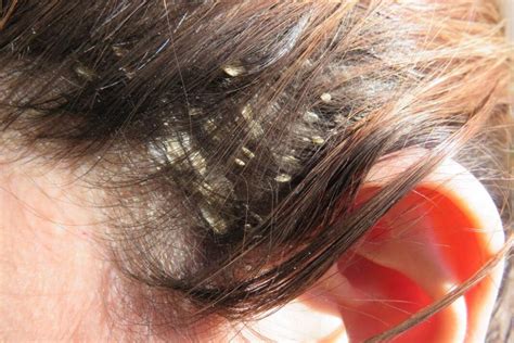 What Causes Scalp Sores And Some Natural Treatments Health Goes Female