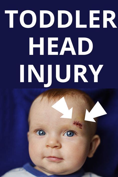 Baby And Toddler Head Injury How To Be Prepared In 2020 Toddler Head