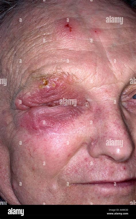 Herpes Zoster Gürtelrose Hautausschlag Im Gesicht Stockfotografie Alamy