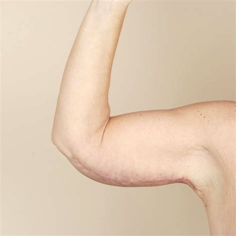 The Arm Lift Surgery Is Recommended For Patients Who Are Close To Their