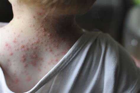 What Common Skin Rashes In Kids Look Like 2022