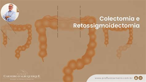 Colectomia E Retossigmoidectomia Prof Dr Luiz Carneiro CRM 22761